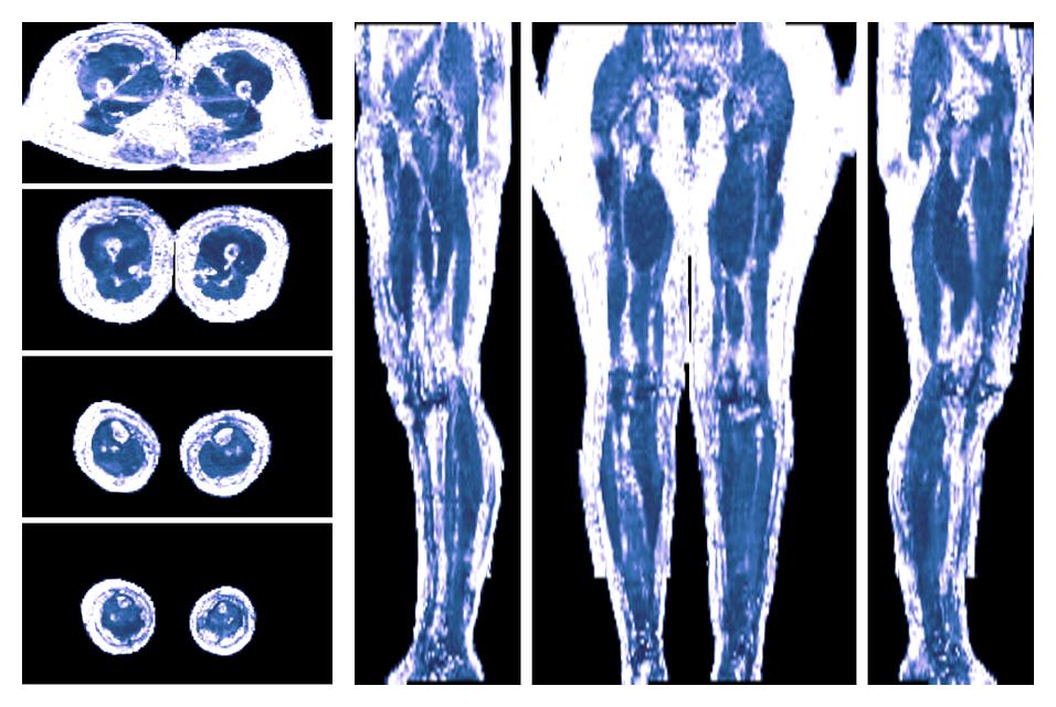 IVIM corrected whole leg muscle fractional anisotropy obtained from diffusion tensor imaging.