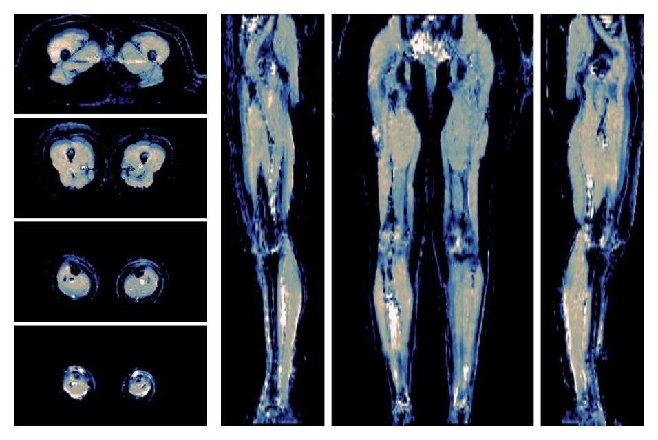 IVIM corrected whole leg muscle mean diffusivity obtained from diffusion tensor imaging.