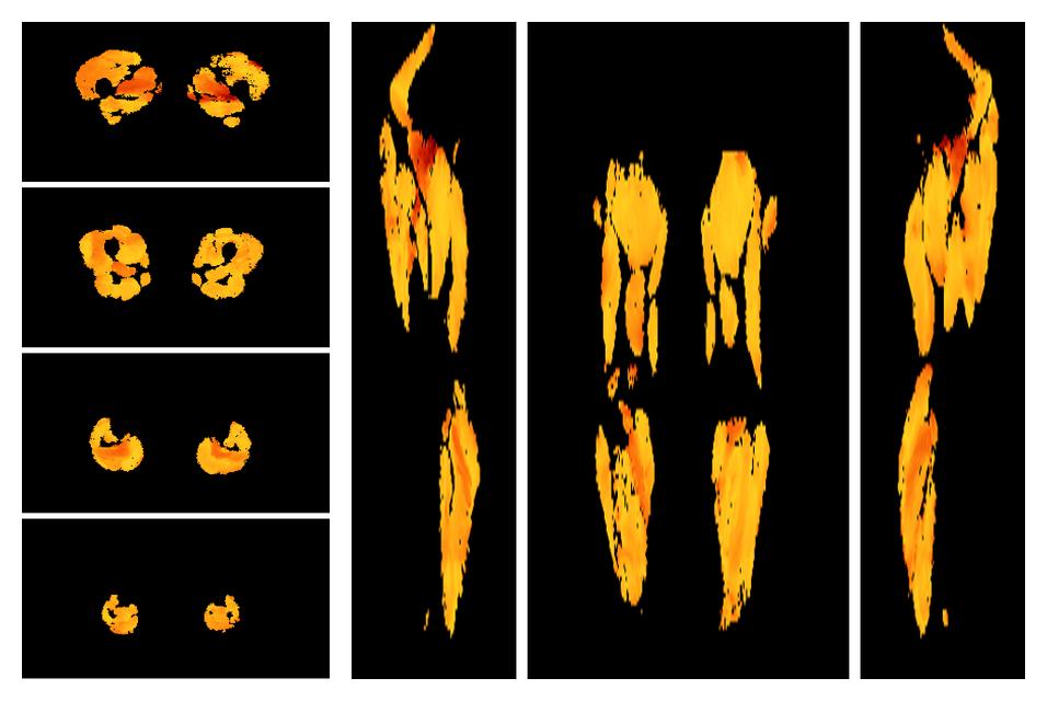 Muscle fiber tract angle map based on whole leg DTI based fiber tractography.