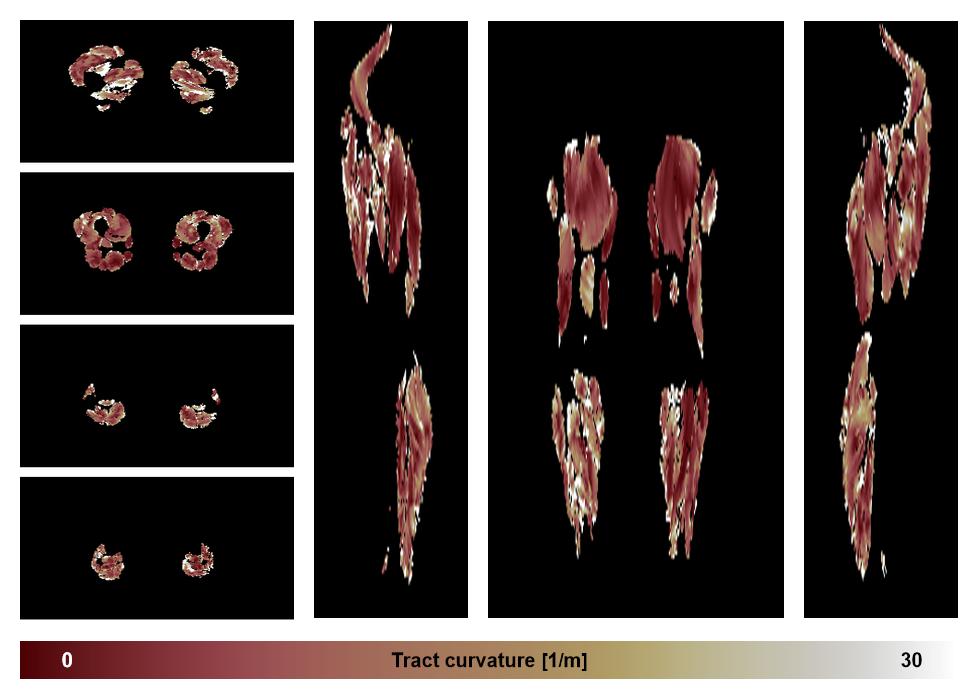 Muscle fiber tract curvature map based on whole leg DTI based fiber tractography.