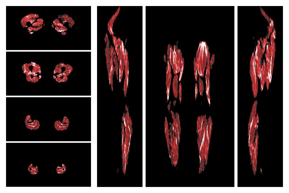 Muscle fiber tract density map based on whole leg DTI based fiber tractography.