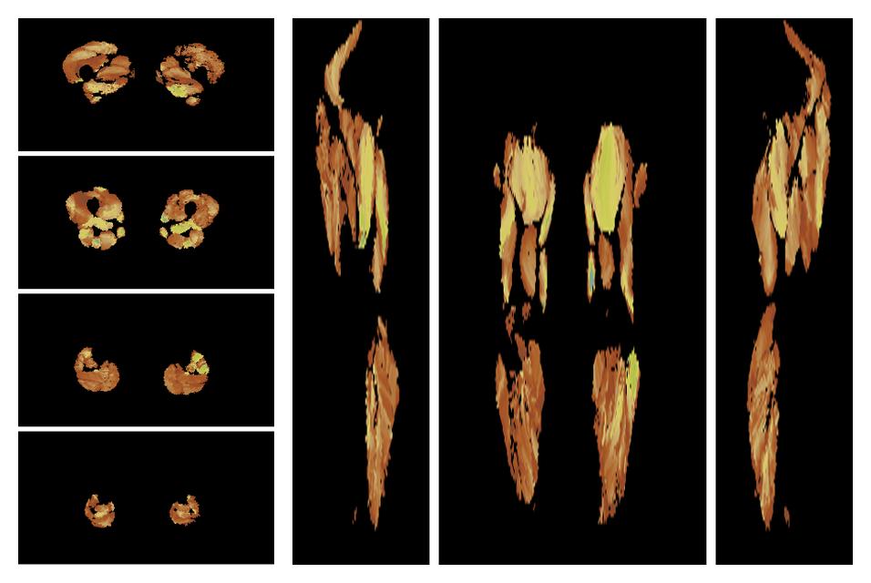 Muscle fiber tract length map based on whole leg DTI based fiber tractography.