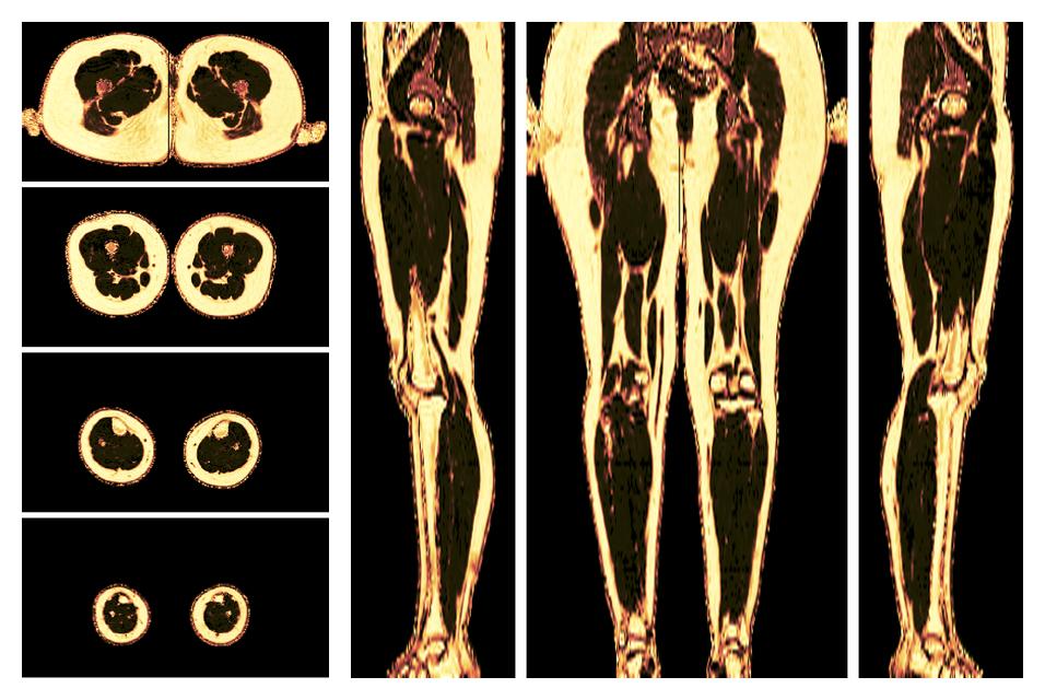 The fat fraction of the lower extremity obtained from the dixon reconstruction for muscle water fat quantification.