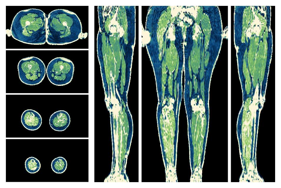 The R2 star relaxation time of the lower extremity obtained from the dixon reconstruction for muscle water fat quantification.