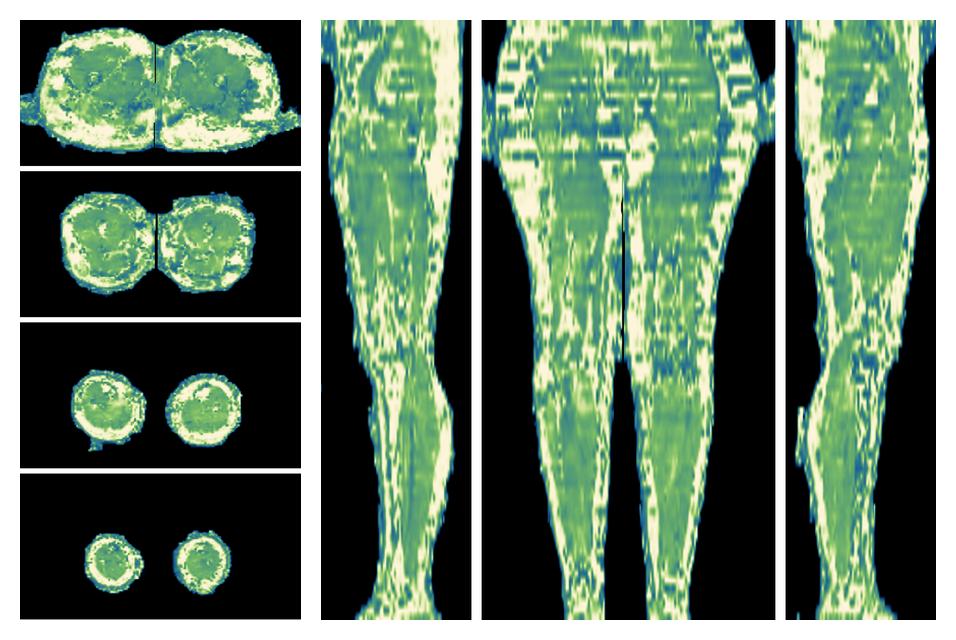 The water only T2 relaxation time of the lower extremity obtained from multi echo spin echo t2 mapping with EPG based reconstruction.