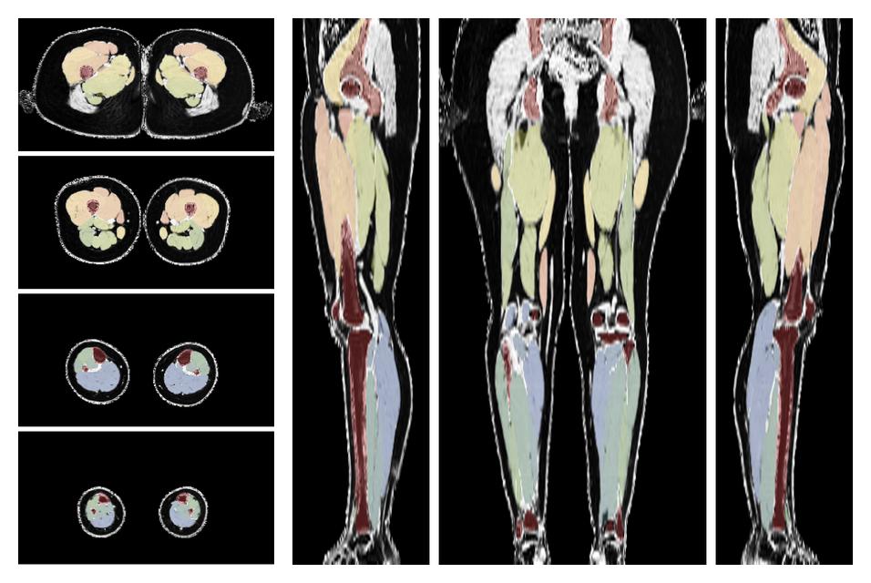 Overlay of automated muscle segmentation labels on dixon water image.