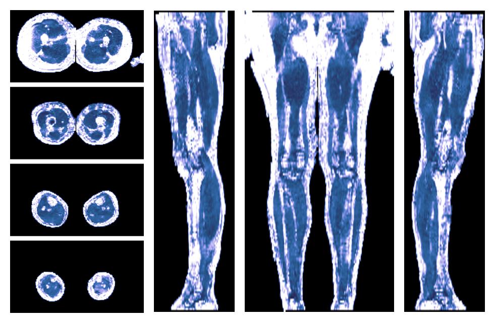 IVIM corrected whole leg muscle fractional anisotropy obtained from diffusion tensor imaging.