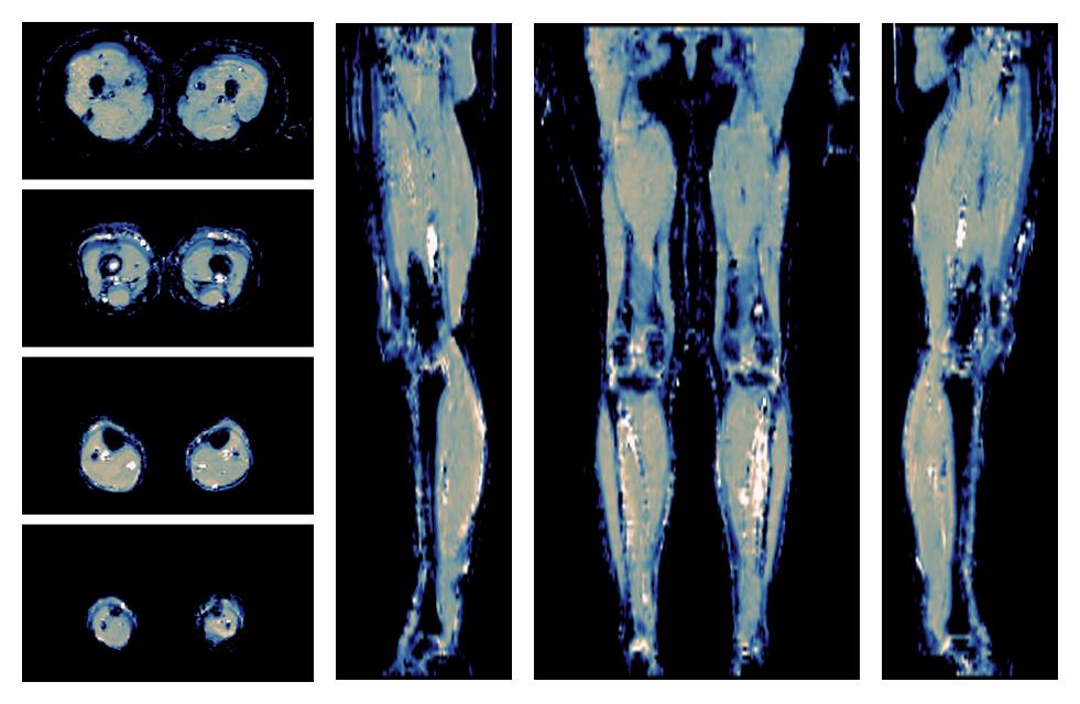 IVIM corrected whole leg muscle mean diffusivity obtained from diffusion tensor imaging.