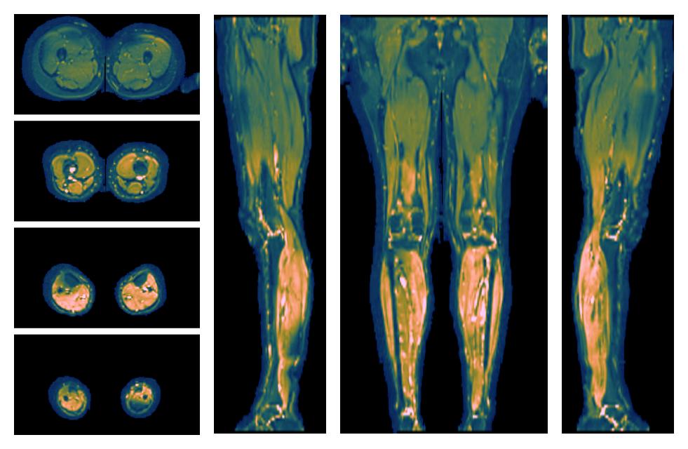 SNR distribution of the unweighted diffusion data.