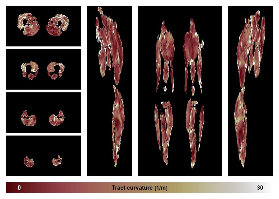 Muscle fiber tract curvature map based on whole leg DTI based fiber tractography.