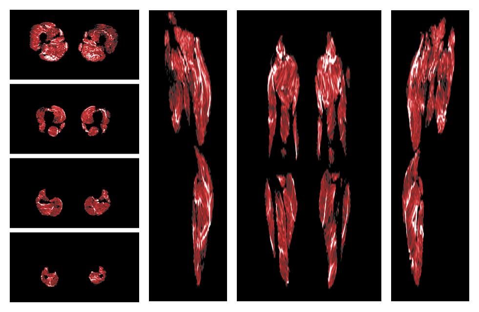 Muscle fiber tract density map based on whole leg DTI based fiber tractography.