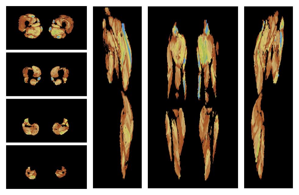 Muscle fiber tract length map based on whole leg DTI based fiber tractography.