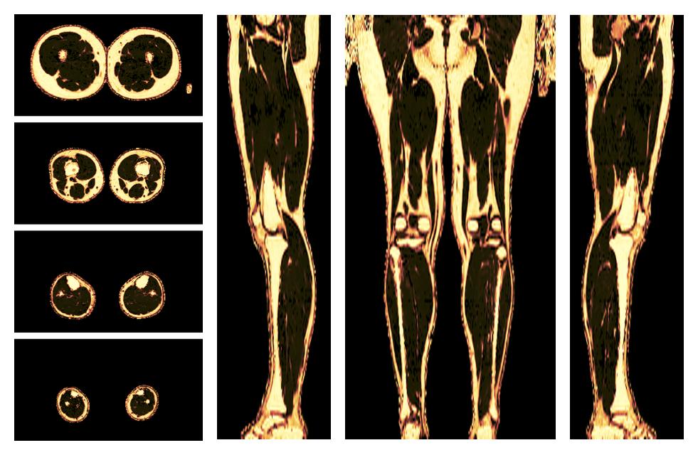 The fat fraction of the lower extremity obtained from the dixon reconstruction for muscle water fat quantification.