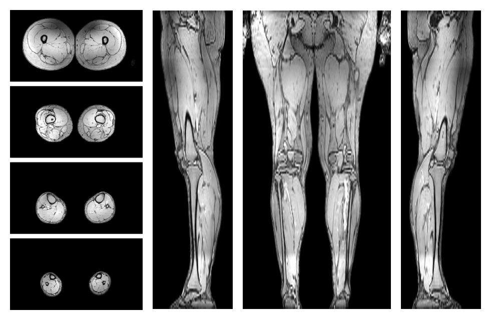 The out-phase image of the dixon reconstruction for water fat quantification.