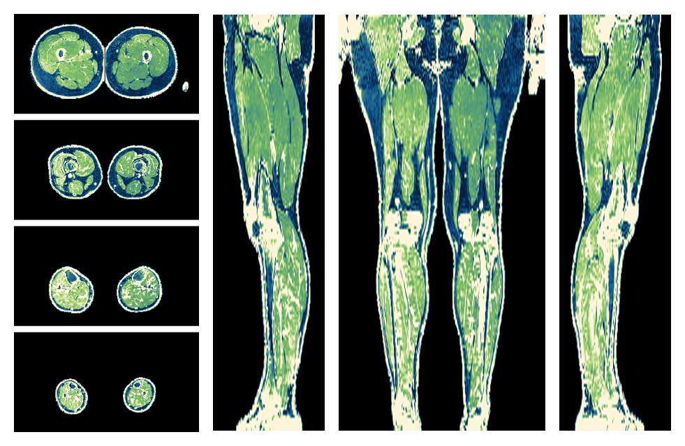 The R2 star relaxation time of the lower extremity obtained from the dixon reconstruction for muscle water fat quantification.