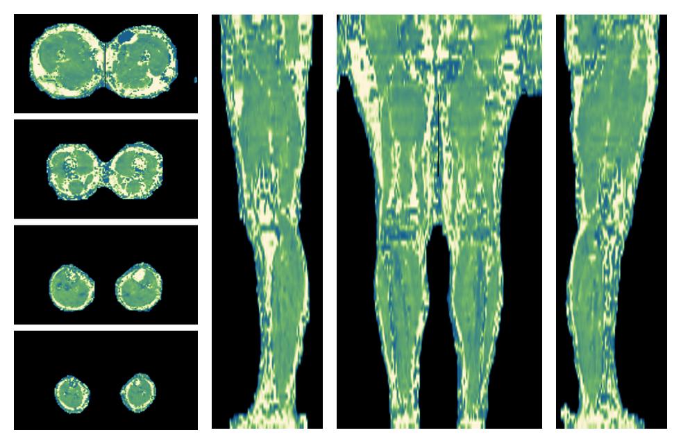 The water only T2 relaxation time of the lower extremity obtained from multi echo spin echo t2 mapping with EPG based reconstruction.