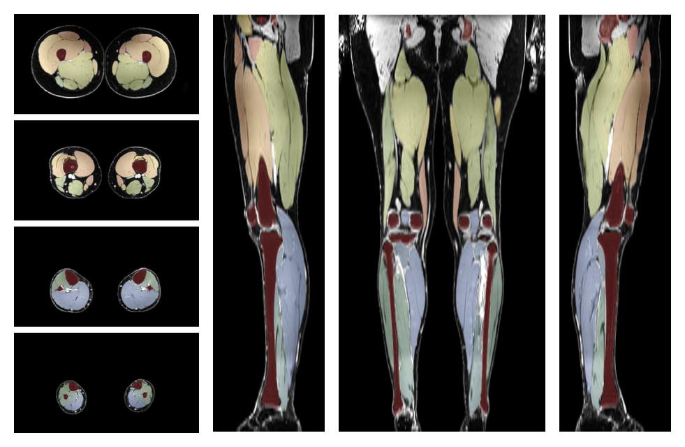 Overlay of automated muscle segmentation labels on dixon water image.