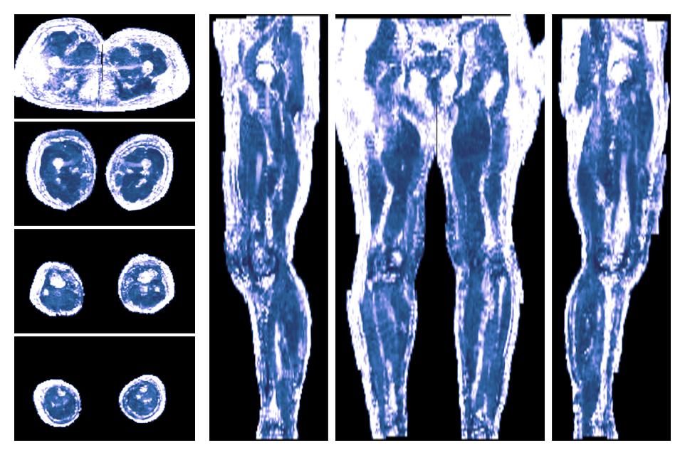 IVIM corrected whole leg muscle fractional anisotropy obtained from diffusion tensor imaging.