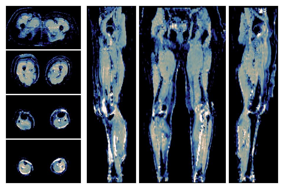 IVIM corrected whole leg muscle mean diffusivity obtained from diffusion tensor imaging.