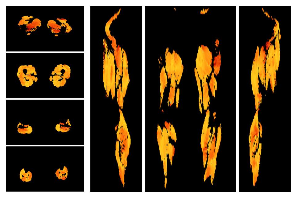 Muscle fiber tract angle map based on whole leg DTI based fiber tractography.