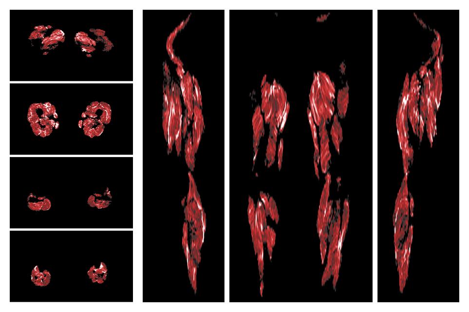 Muscle fiber tract density map based on whole leg DTI based fiber tractography.