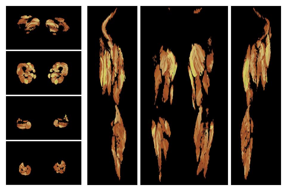 Muscle fiber tract length map based on whole leg DTI based fiber tractography.