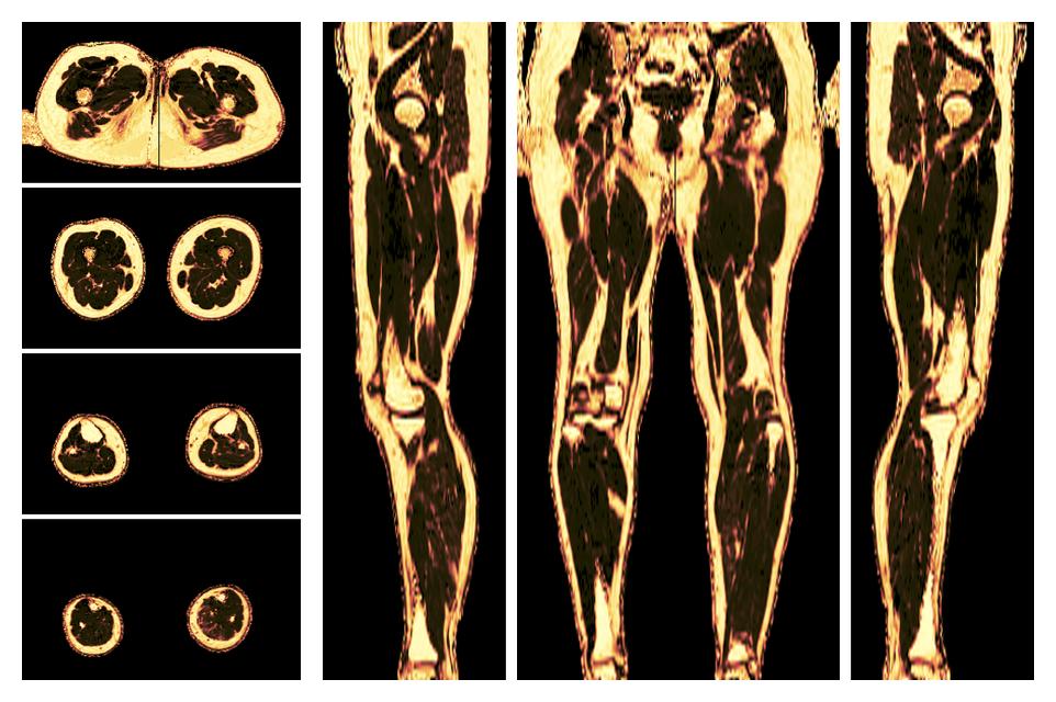 The fat fraction of the lower extremity obtained from the dixon reconstruction for muscle water fat quantification.