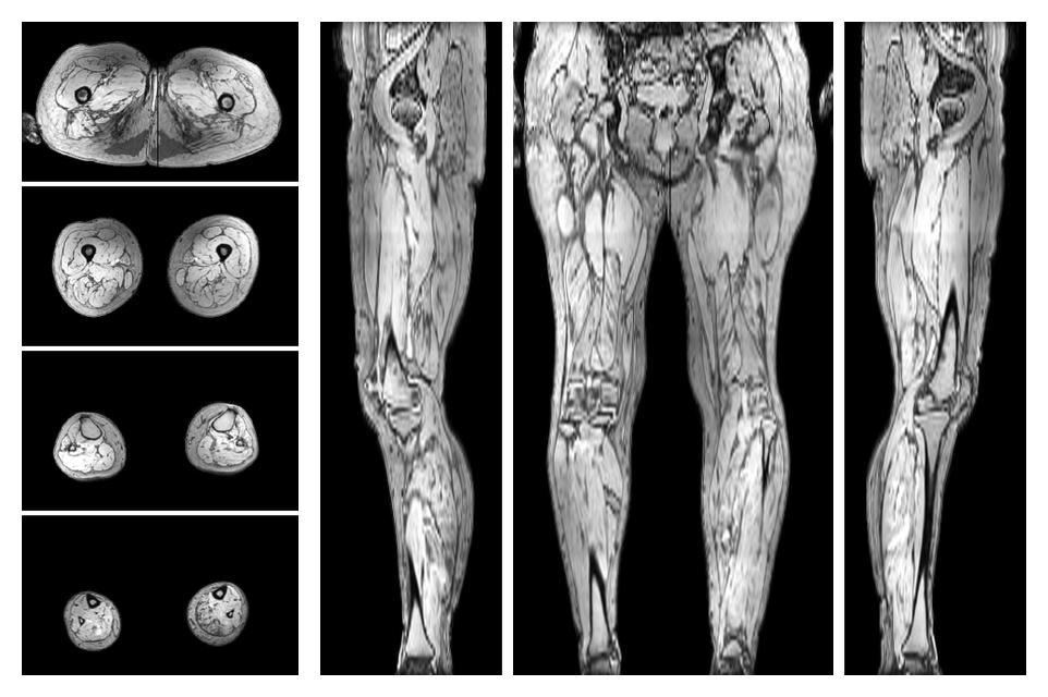 The out-phase image of the dixon reconstruction for water fat quantification.