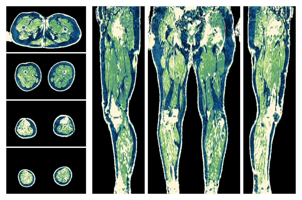 The R2 star relaxation time of the lower extremity obtained from the dixon reconstruction for muscle water fat quantification.