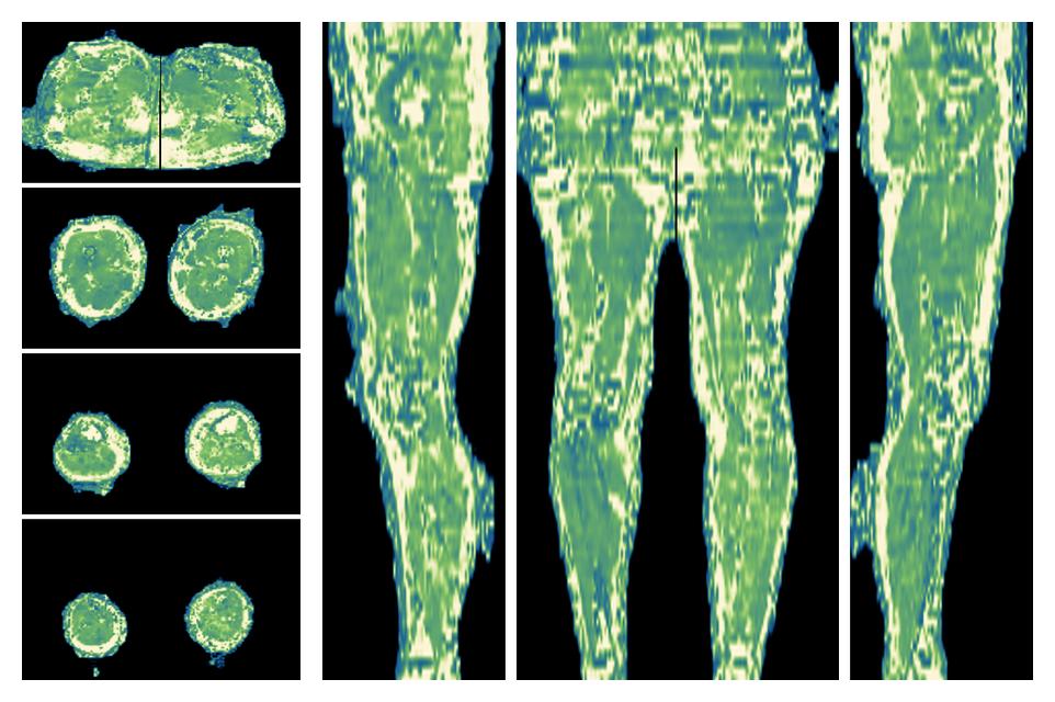 The water only T2 relaxation time of the lower extremity obtained from multi echo spin echo t2 mapping with EPG based reconstruction.