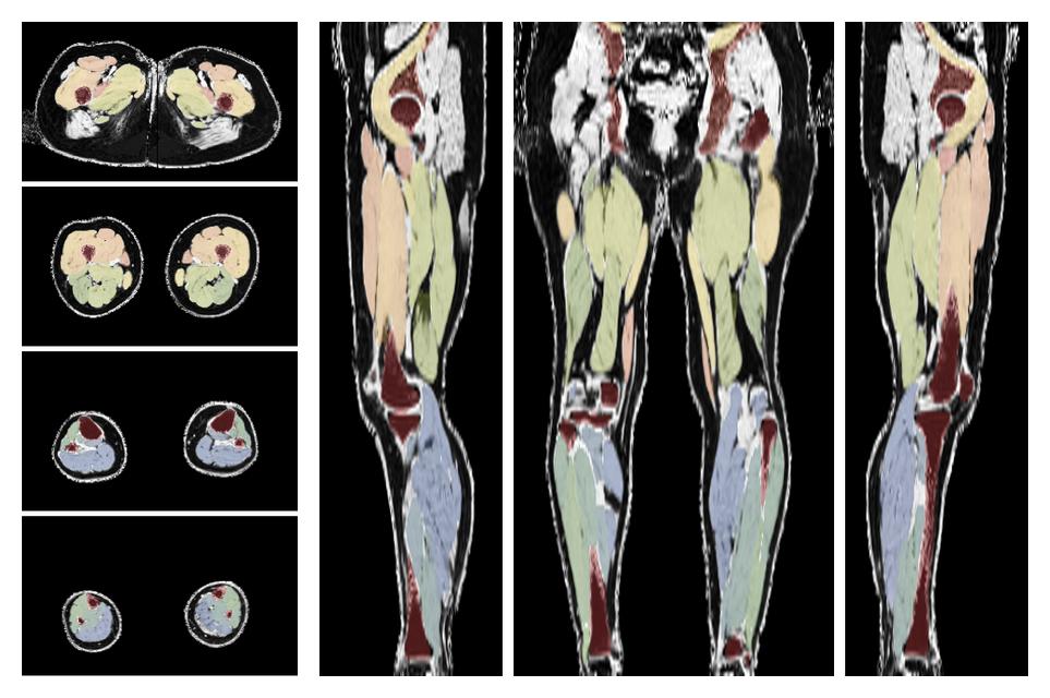 Overlay of automated muscle segmentation labels on dixon water image.