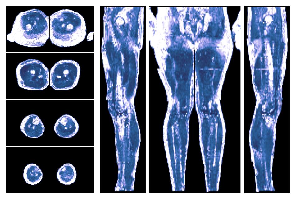 IVIM corrected whole leg muscle fractional anisotropy obtained from diffusion tensor imaging.