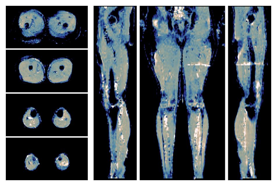 IVIM corrected whole leg muscle mean diffusivity obtained from diffusion tensor imaging.