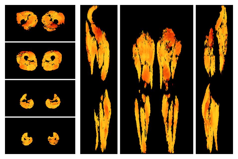 Muscle fiber tract angle map based on whole leg DTI based fiber tractography.