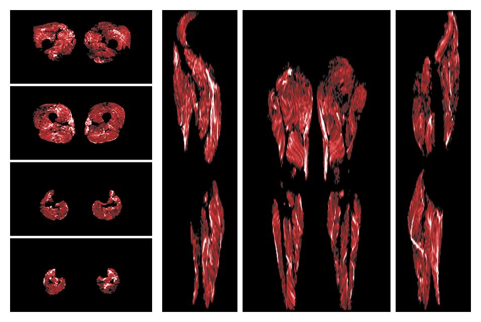 Muscle fiber tract density map based on whole leg DTI based fiber tractography.