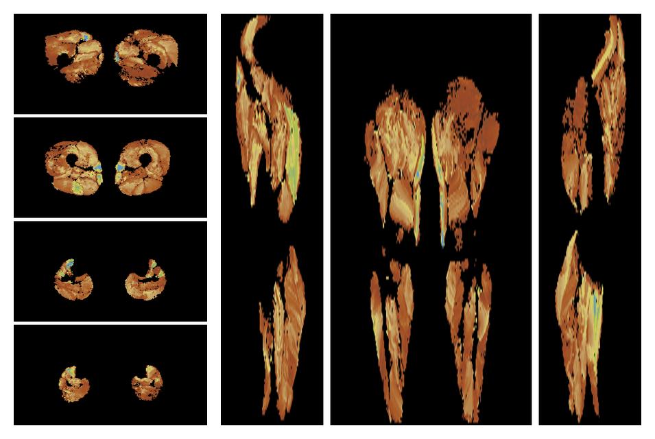 Muscle fiber tract length map based on whole leg DTI based fiber tractography.