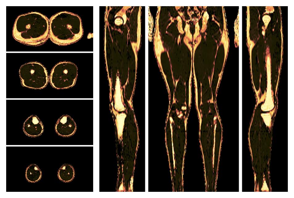 The fat fraction of the lower extremity obtained from the dixon reconstruction for muscle water fat quantification.