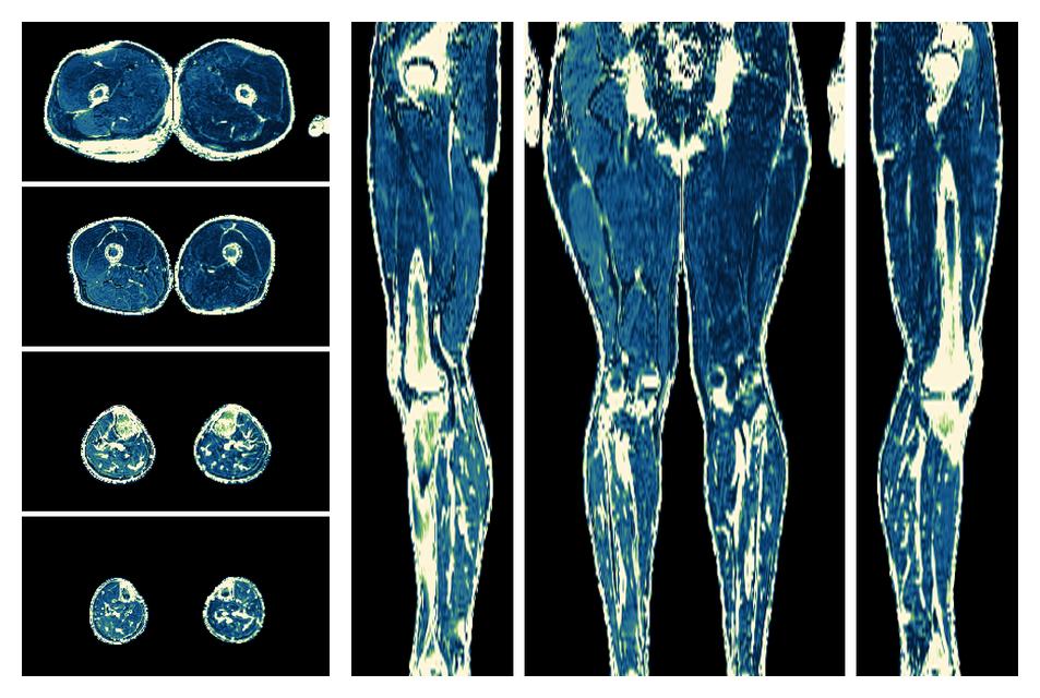 The R2 star relaxation time of the lower extremity obtained from the dixon reconstruction for muscle water fat quantification.