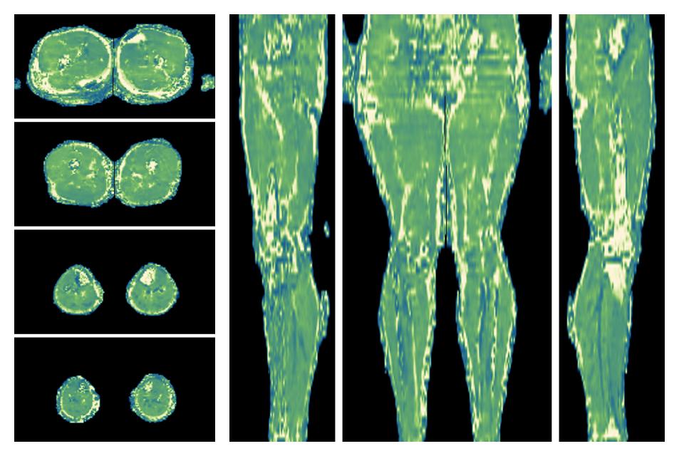 The water only T2 relaxation time of the lower extremity obtained from multi echo spin echo t2 mapping with EPG based reconstruction.