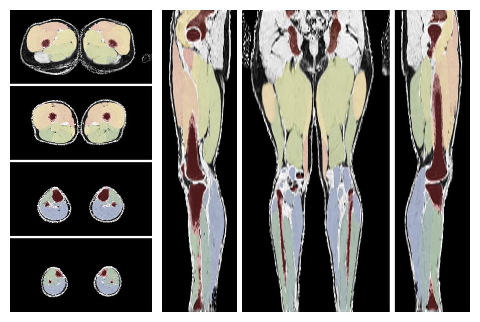 Overlay of automated muscle segmentation labels on dixon water image.