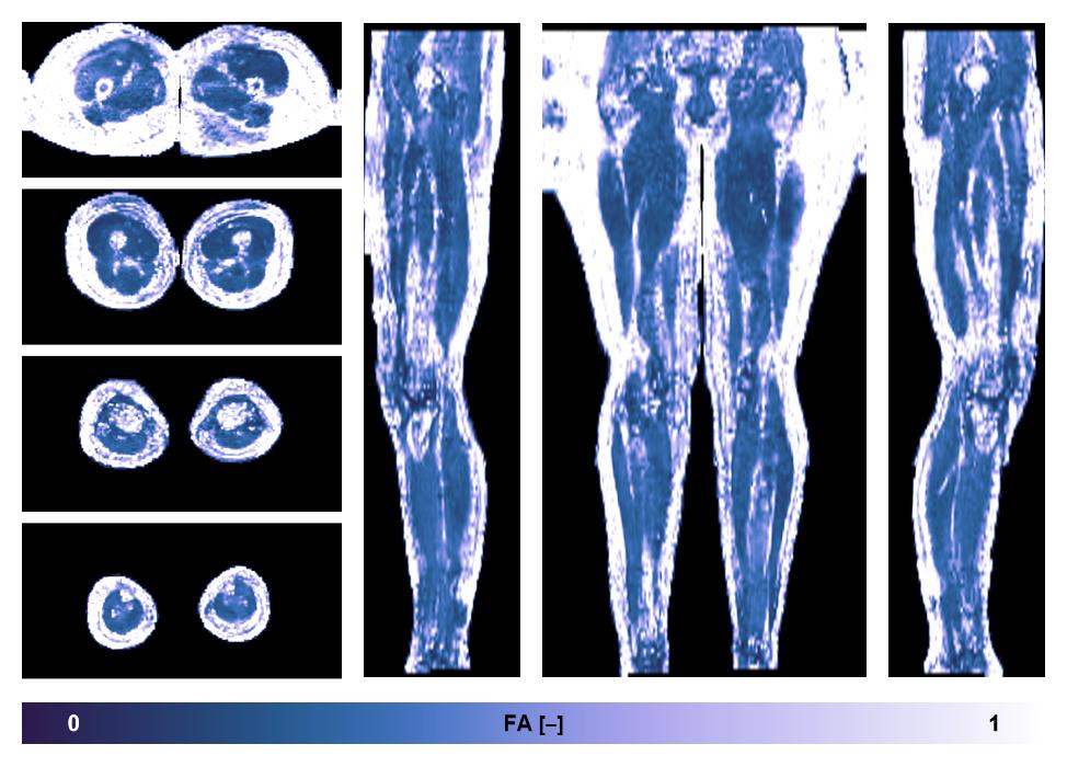 IVIM corrected whole leg muscle fractional anisotropy obtained from diffusion tensor imaging.