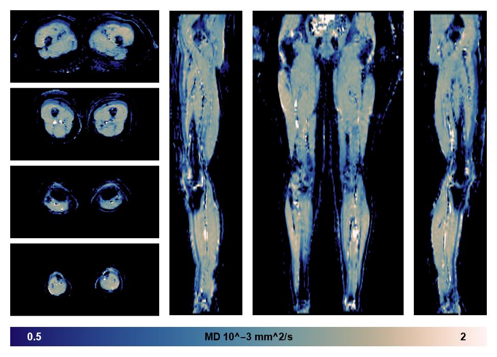 IVIM corrected whole leg muscle mean diffusivity obtained from diffusion tensor imaging.