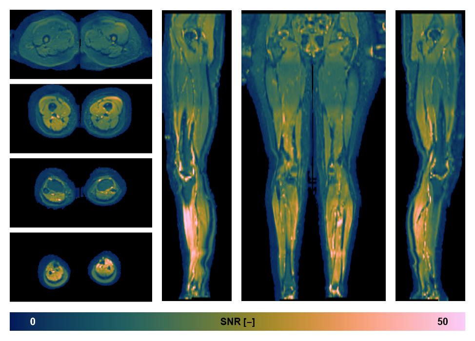 SNR distribution of the unweighted diffusion data.