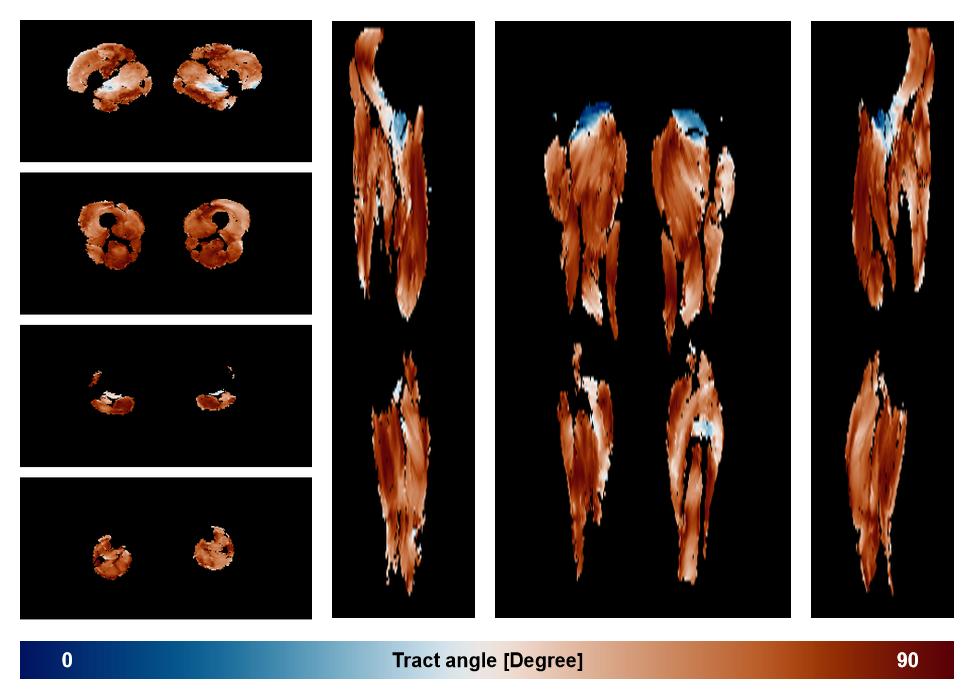 Muscle fiber tract angle map based on whole leg DTI based fiber tractography.