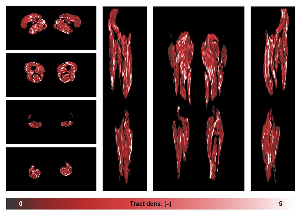 Muscle fiber tract density map based on whole leg DTI based fiber tractography.