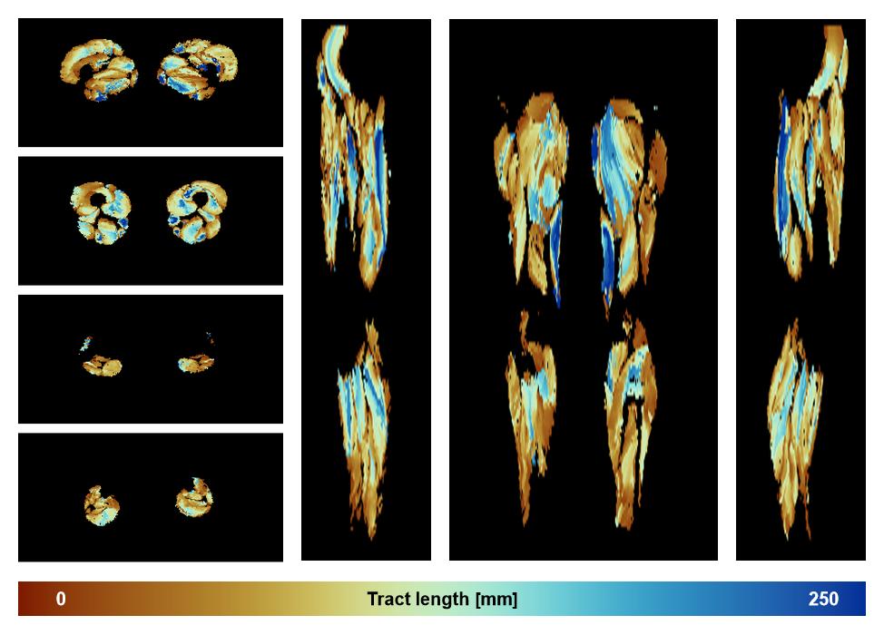 Muscle fiber tract length map based on whole leg DTI based fiber tractography.