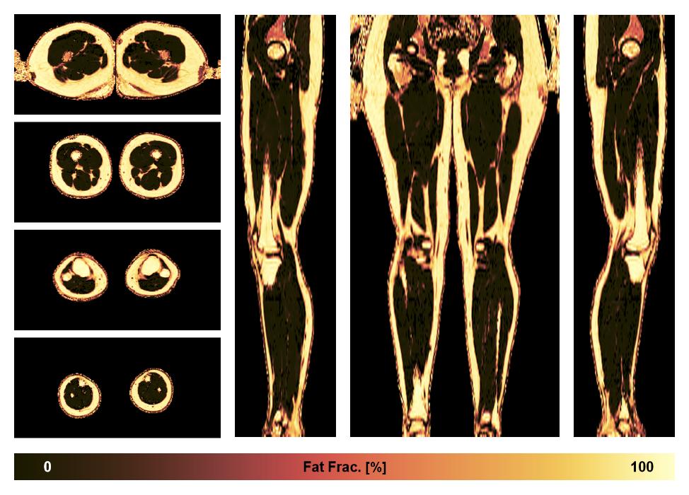 The fat fraction of the lower extremity obtained from the dixon reconstruction for muscle water fat quantification.