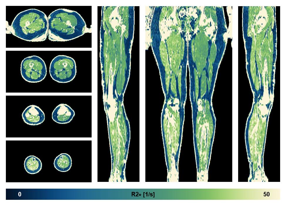 The R2 star relaxation time of the lower extremity obtained from the dixon reconstruction for muscle water fat quantification.