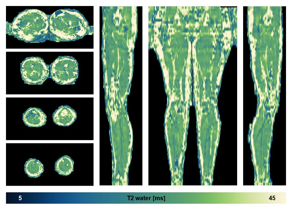 The water only T2 relaxation time of the lower extremity obtained from multi echo spin echo t2 mapping with EPG based reconstruction.