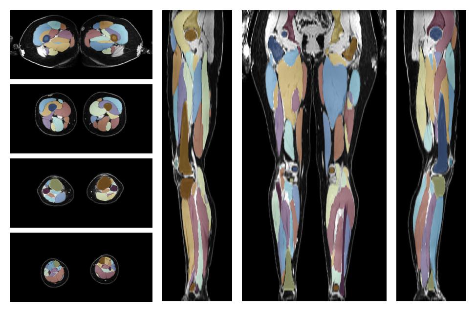 Overlay of automated muscle segmentation labels on dixon water image.